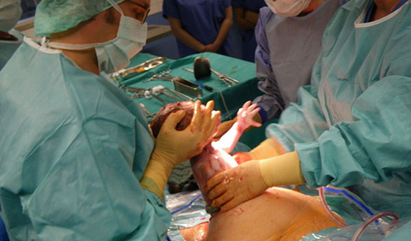 Cesarean Delivery Doubles Risk for Childhood Obesity